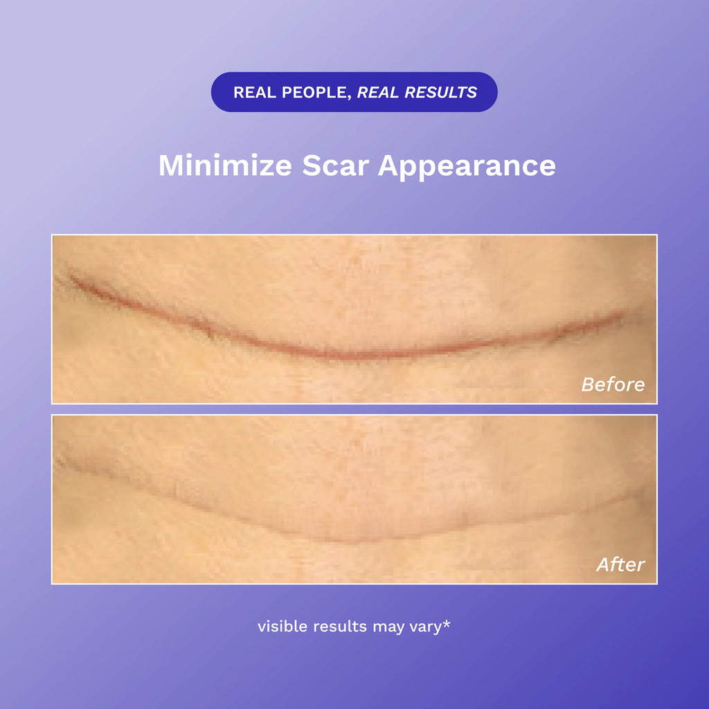 Rejuvaskin Scar Fx Silicone Sheet - 1" x 12"